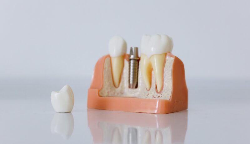 Ankara Protez Diş Hizmetleri: Gönül Ağız ve Diş Sağlığı Kliniği